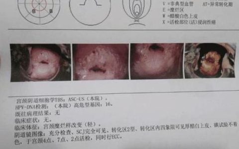 宫颈搔刮术：妇科检查评估宫颈管内异常状况的重要技术？