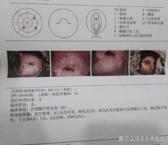 hsk curettage_hsk curettage_hsk curettage